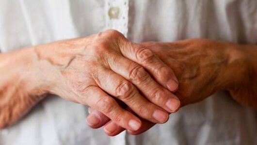 rheumatoid arthritis sebagai punca sakit pada sendi jari