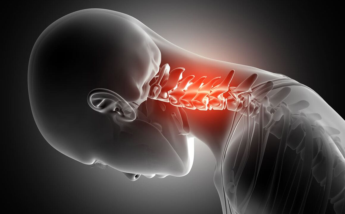 Osteochondrosis tulang belakang serviks