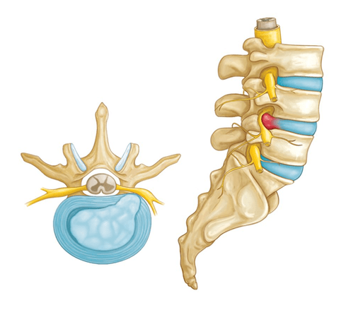 sakit belakang akibat hernia intervertebral