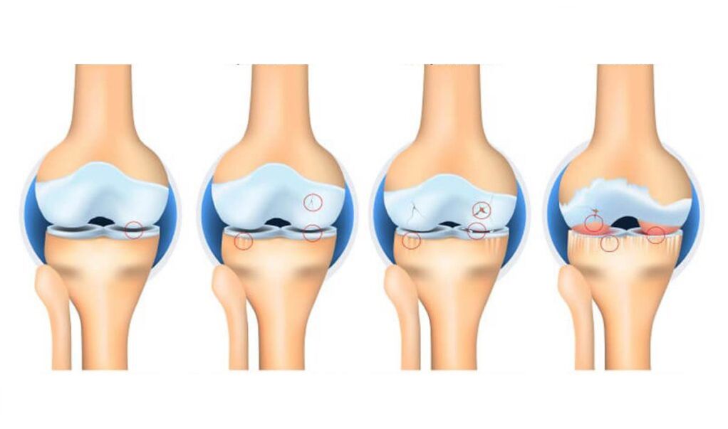 peringkat arthrosis sendi lutut