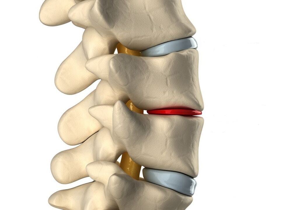 Cakera intervertebral yang sihat (biru) dan rosak akibat osteochondrosis toraks (merah)