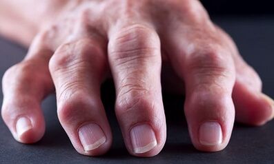 Apakah perbezaan antara arthritis dari arthrosis
