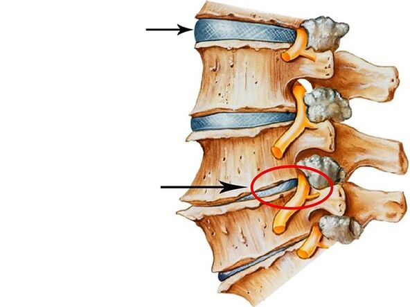 Gangguan dalam cakera intervertebral