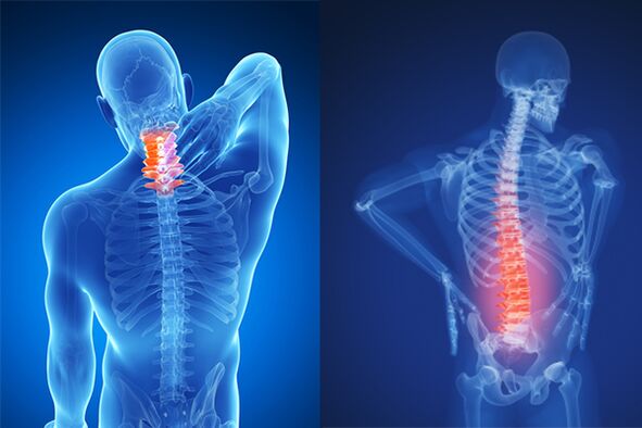 Osteochondrosis tulang belakang serviks dan lumbar