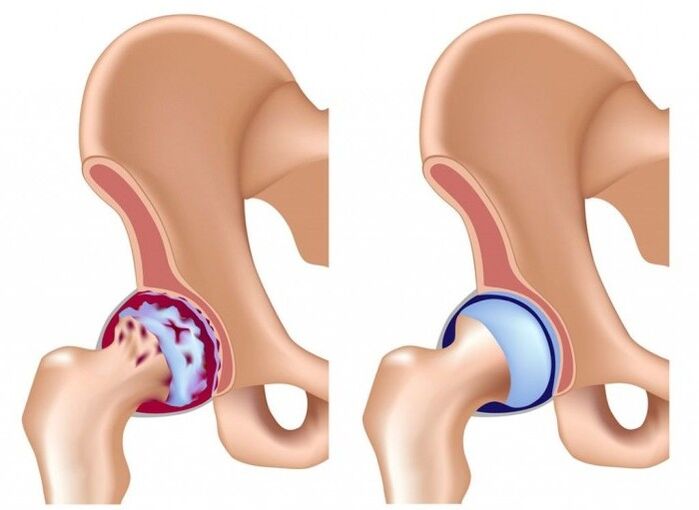 Kerosakan pada sendi pinggul akibat arthrosis