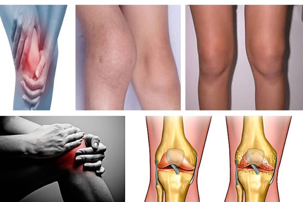 arthrosis apa itu