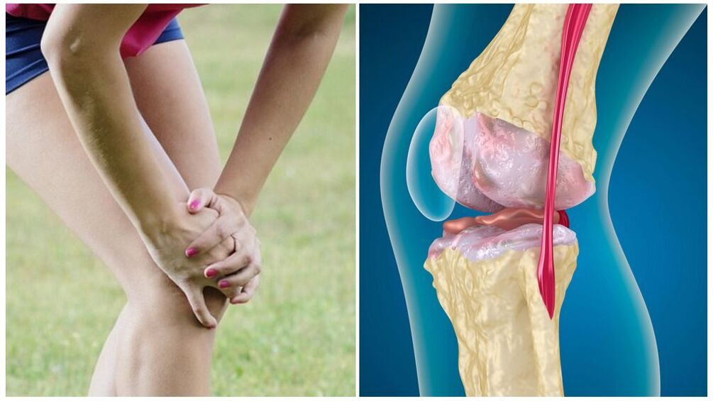 gejala arthrosis