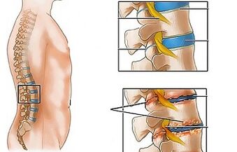 Punca osteochondrosis lumbar