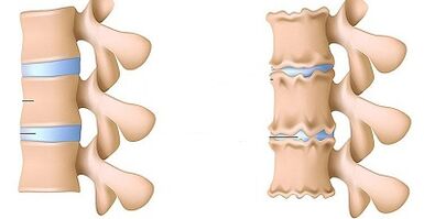 bagaimana mengenali kehadiran osteochondrosis lumbar