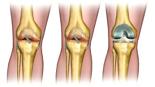 endoprosthetics untuk arthrosis sendi lutut